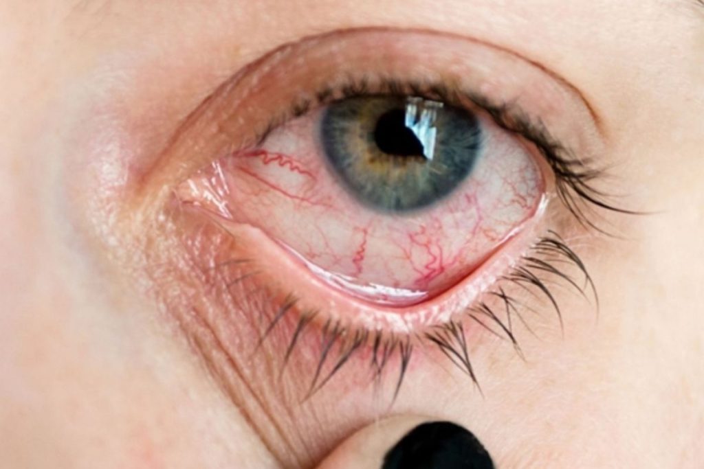 چرا بعد از شنا چشم کودکان می‌سوزد و قرمز می‌شود؟